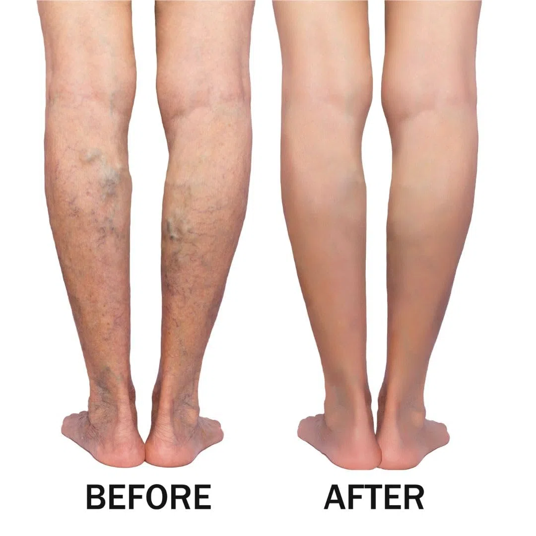 Green idea - Gel de Massage au Marron d'Inde et Arnica contre les Varices 250 ml - Traitement pour Varices et Hémorroïdes - Améliore la Circulation Sanguine - Soulage Rapidement - Veines Saines | Crème Jambes à l'arnica, Marronnier, Rutine, Contre les var