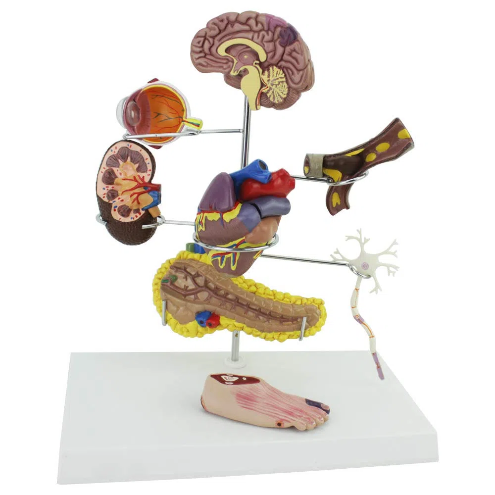 Outils de modèle d'enseignement, modèle de diabète Humain, modèle de cœur, thrombose coronarienne, modèle de diabète artériel, Circulation extracorporelle, vaisseaux sanguins, cerv